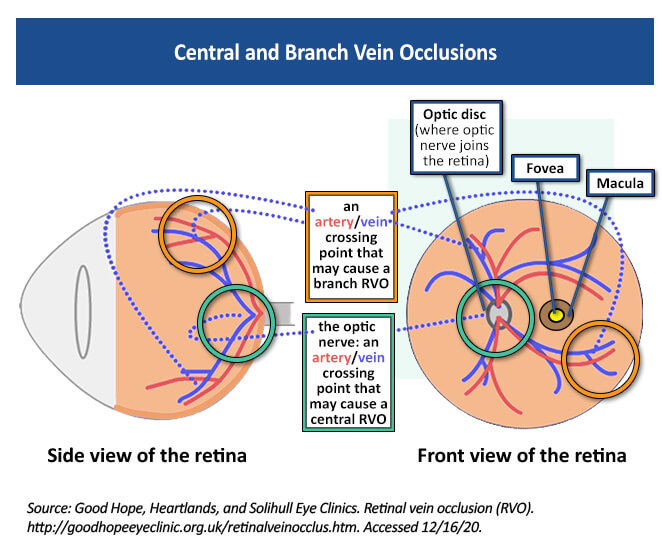 Educación sobre la enfermedad de oclusión de la vena retiniana